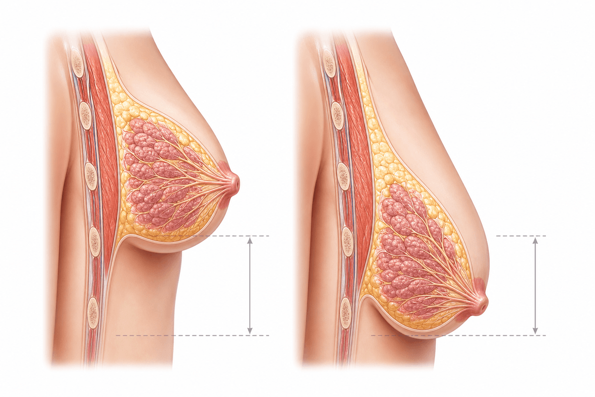 Breast Ptosis