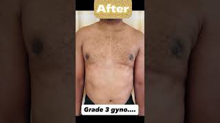 Gynecomastia transformation by Dr. Madhusudhan