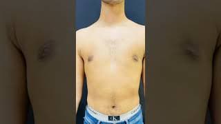 Real Transformation. Real Confidence. ✨Gynecomastia
