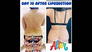 Liposuction results!!!!!