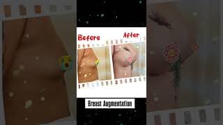 Breast augmentation before & after results!!!!
