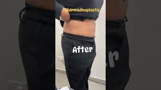 Abdominoplasty