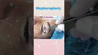Blepharoplasty surgery