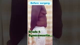Grade 4 gynecomastia results
