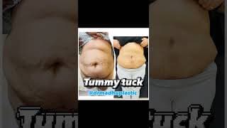 Tummy tuck transformation