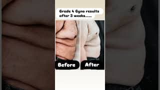 Grade 4 gynecomastia results!!!!!