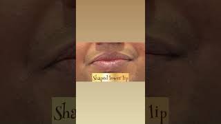 Bulky lower lips