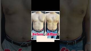 Gynecomastia before and after transformation