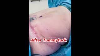 Abdominoplasty