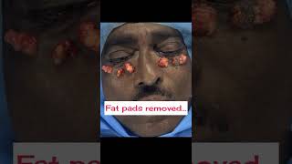 Blepharoplasty surgery