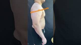 Gynecomastia
