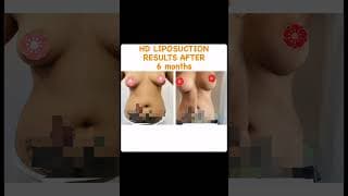 HD Liposuction