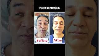 Ptosis correction