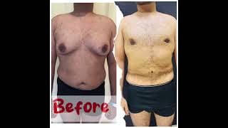 Body Contouring