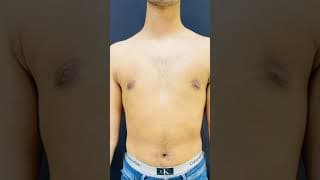 Real Transformation Real Confidence ✨Gynecomastia treatment helps reshape the chest.
