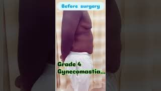 Gynecomastia transformation