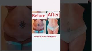 Tummy tuck before and after results