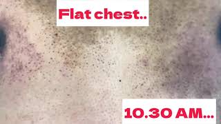Gynecomastia