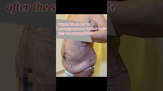 Mommy makeover transformation check this out!!!