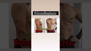 Gynecomastia