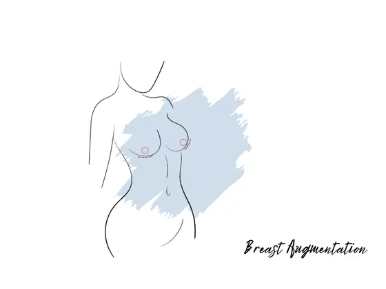 breast-augmentation