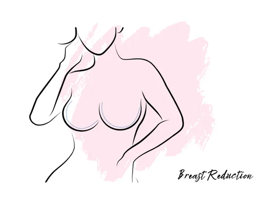 breast-reduction