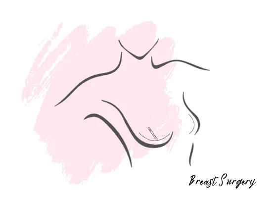 breast-surgery