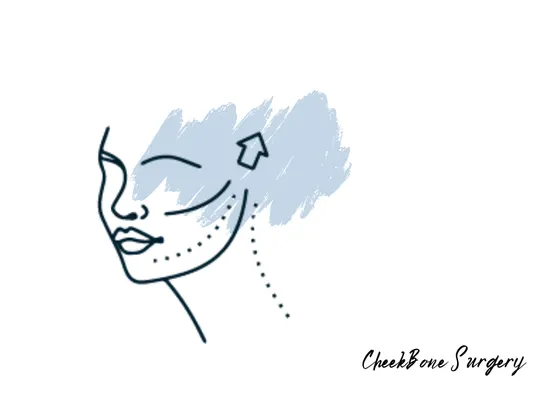 cheekbone-surgery