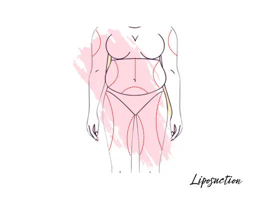 liposuction