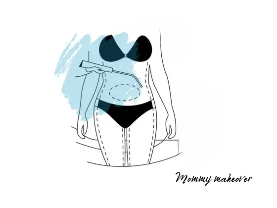 mommy-makeover