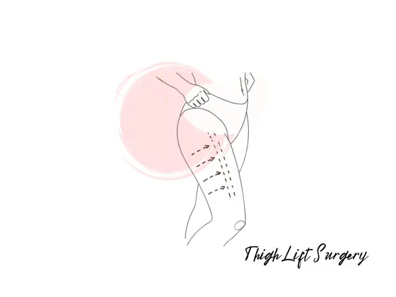 thigh-lift-surgery